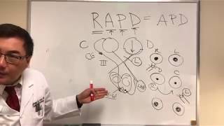 RAPD Relative Afferent Pupillary Defect MarcusGunn pupil [upl. by Lonni]