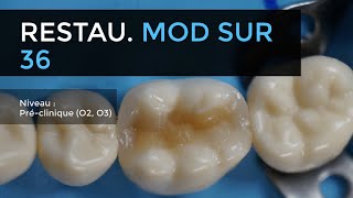 105  Restauration MOD en résine composite sur molaire mandibulaire [upl. by Hentrich749]