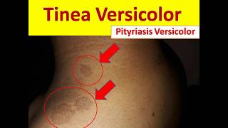 Tinea Versicolor in Young People  Pityriasis Versicolor [upl. by Enylecoj603]