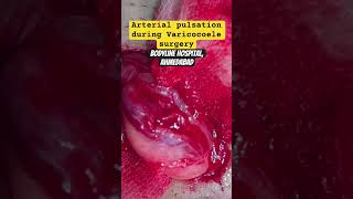 Testicular Artery pulsation during Varicocoele surgery varicoceletreatment andrologist urologist [upl. by Ylil]