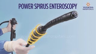 Power Spiral Enteroscopy A New Technology to Diagnose and Treat Small Intestine Diseases [upl. by Notrab]