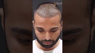 Hair Transplant Journey Day By Day  Artas Robotic Hair Transplant  Musk Clinic [upl. by Ruthann]