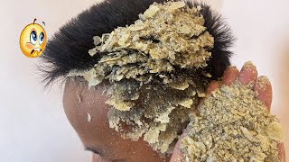 BOYS DANDRUFF Itchy psoriasis dandruff Scratching  V134 [upl. by Eceer]