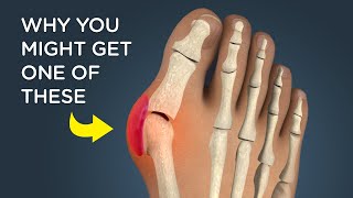 Bunions What Causes Them and How Theyre Removed [upl. by Sheffie]