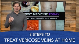 3 Steps to Treat Varicose Veins at Home [upl. by Iniretake]