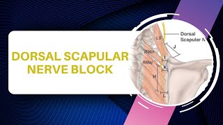 Dorsal Scapular Nerve Injection Technique [upl. by Ziguard]