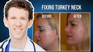 Dr Scheiner on Fox Kybella Treatment for Turkey Neck [upl. by Jenks]