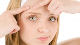 How to Get Rid of Forehead Acne Acne Scars Treatment Removal Medication Cure Home Remedies [upl. by Notaek]