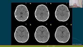 MICROCEPHALY CRANIOSYNSTOSIS [upl. by Nyledam]