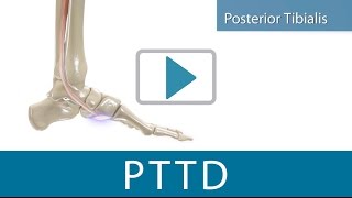 PTTD Relief using the TriLok [upl. by Poppas]