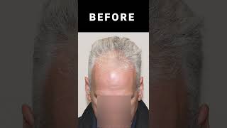 Alma Ted Dutasteride Before and After dutasteride almated mesotherapy hairrestoration Forhair [upl. by Sergeant]