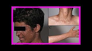 Xeroderma pigmentosum was es ist Symptome und wie die Behandlung ist [upl. by Davida]