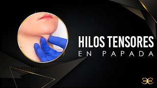 Elevación de cejas con hilos tensores [upl. by Calista]