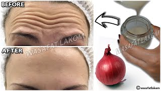 1 onion is a million times stronger than Botox it eliminates wrinkles and fine lines instantly [upl. by Pinebrook288]