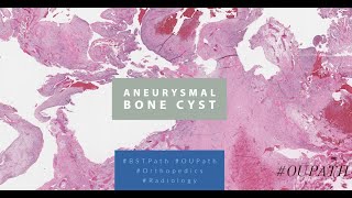 Aneurysmal Bone Cyst [upl. by Cooe]