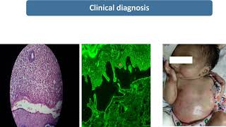 Epidermolysis Bullosa  Spot Diagnosis  9  Pediatrics [upl. by Devondra]