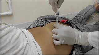 im injection buttock How to Give an IM Intramuscular Injection Ventrogluteal Buttock Muscle [upl. by Swanson]