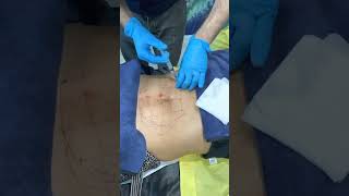 Fat Dissolving Injection to Belly at Beverly Hills Wellness Center amp Med Spa Florida shorts [upl. by Barstow]