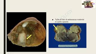 GAME 17 I Teratoma  Dr G Shivashekar  SRM  Pathology  MBBS Practicals slides amp specimens [upl. by Glyn]