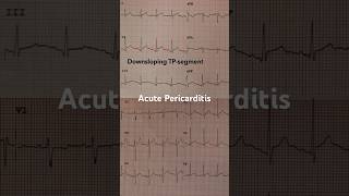 Acute Pericarditis ECG Downsloping TP segment [upl. by Imhskal]