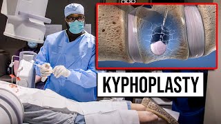 Kyphoplasty  Outpatient  Same Day Procedure for Vertebral Compression Fractures [upl. by Gleason]