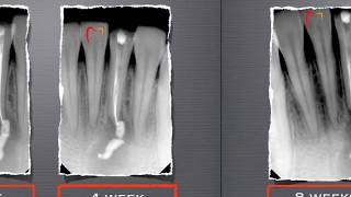 Endodontic Treatment of a Chronic Lesion [upl. by Boyden]