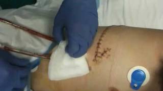 Rideys chest tube removal [upl. by Supen661]