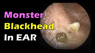 Monster Blackhead in Ear [upl. by Yesteb]