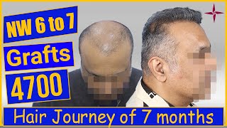 Hair Transplantation Result in 7 Months 4700 Grafts Grade 6 Eugenix by Drs Sethi amp Bansal [upl. by Calle222]