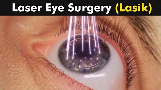 شاهد عملية الليزك تصحيح البصر  LASIK eye surgery l 3d animation [upl. by Thorrlow]