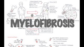 Primary Myelofibrosis  Overview presentation pathophysiology investigation treatment [upl. by Ressler]