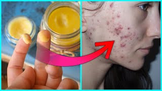 Acne  Pimple को ठीक करें दाग धब्बे और निशान मिटायें  Get Rid of Pimples Acne Naturally [upl. by Nauquf]