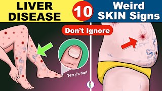 10 Skin signs of Liver Disease  Fatty liver  Cirrhosis of the Liver  Fatty liver Symptoms [upl. by Ellener]