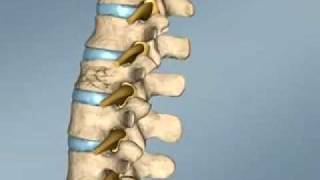 Spine Surgery Croatia  Vertebroplasty [upl. by Areehs]