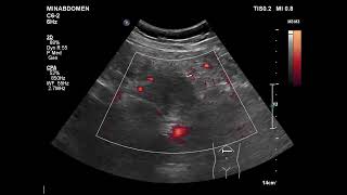 unmatching sono amp CT on pancreas [upl. by Waltner]