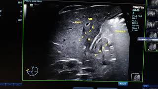 Hypertrophic Pyloric Stenosis HPS [upl. by Troy656]