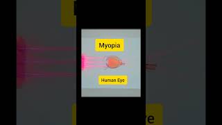 Human eye myopia myopia treatmentmyopia can be cured myopia treatment in hindi humaneye myopia [upl. by Aerdnahc]