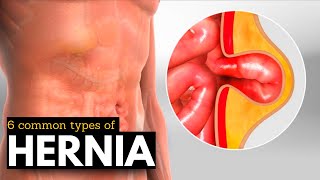 Hernia Breakdown Discovering the 6 Most Prevalent Types [upl. by Peddada]