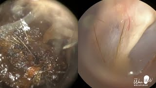 157  Severe Ear Wax Extraction From Difficult Twisty Ear using the WAXscope®️ [upl. by Auqenat]