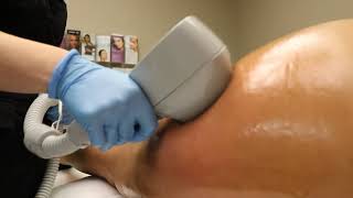 Exilis Ultra Body Sculpting Skin Tightening Portland OR  Leg Treatments [upl. by Owens]