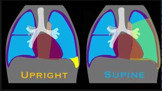 Pleural Effusion Explained by Prometheus Lionhart MD [upl. by Esinned870]