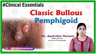 Classic bullous pemphigoid Clinical essentials Dr Aashritha yerneni [upl. by Rabiah]