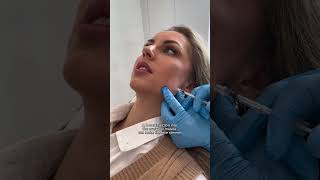 Masseter botox against grinding and clenching [upl. by Aniloj]