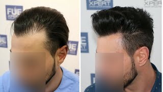 FUE Hair Transplant Repair 1200 Grafts NW III A By Dr Juan Couto  FUEXPERT CLINIC Madrid Spain [upl. by Acceber]