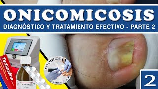 PARTE 2 ONICOMICOSIS  Diagnóstico y Tratamiento Efectivo  Podología Casos y Cosas [upl. by Randee]