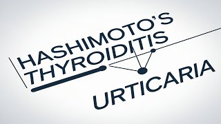 Understanding the Link Between Chronic Spontaneous Urticaria and Thyroid Health [upl. by Akemeuwkuhc]