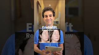 Stunning EndoLift Results Erase Jowls and Double Chin in Just Months [upl. by Ahsirhcal]