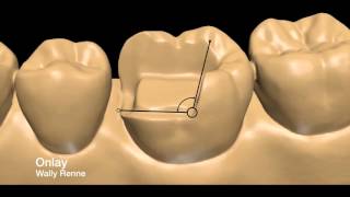 Posterior tooth preparations inlay onlay crownlay and crown [upl. by Flip]