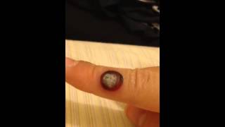 wart on finger after freezing with liquid nitrogen [upl. by Pimbley]