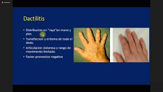 Artritis Psoriásica y sus Diferencias con Artritis Rematoide 11 [upl. by Ikcim581]